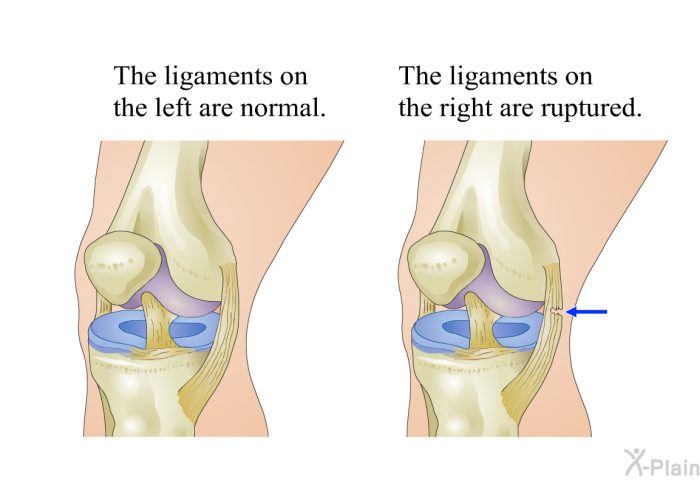 The ligaments on the left are normal. The ligaments on the right are ruptured.