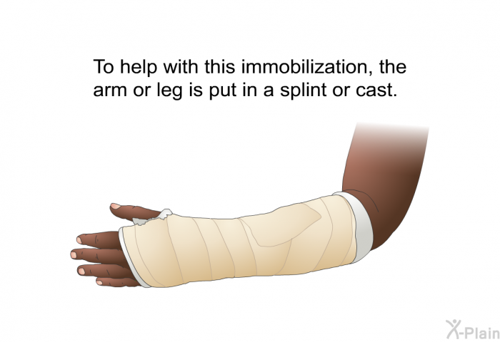 To help with this immobilization, the arm or leg is put in a splint or cast.