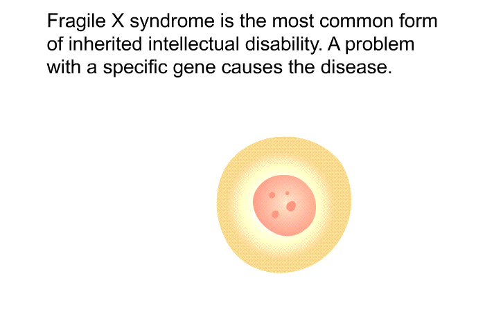 Fragile X syndrome is the most common form of inherited intellectual disability. A problem with a specific gene causes the disease.