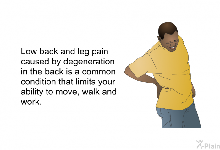 Low back and leg pain caused by degeneration in the back is a common condition that limits your ability to move, walk and work.