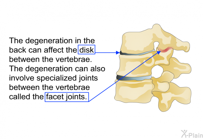 The degeneration in the back can affect the disk between the vertebrae. The degeneration can also involve specialized joints between the vertebrae called the facet joints.