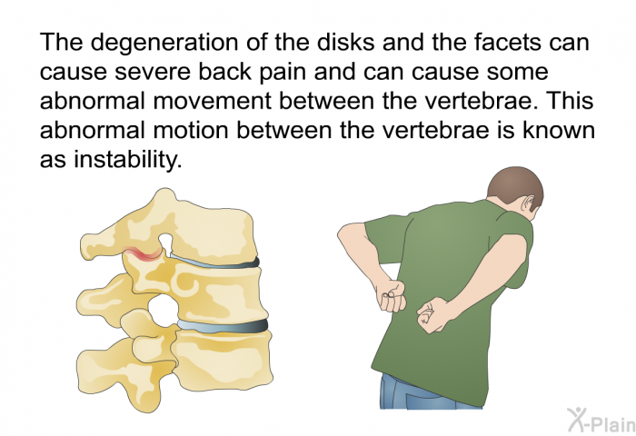 The degeneration of the disks and the facets can cause severe back pain and can cause some abnormal movement between the vertebrae. This abnormal motion between the vertebrae is known as instability.