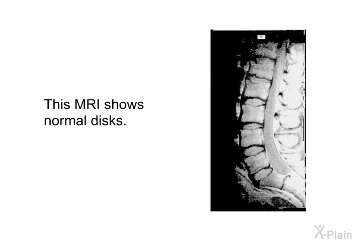 This MRI shows normal disks.