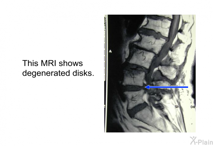 This MRI shows degenerated disks.