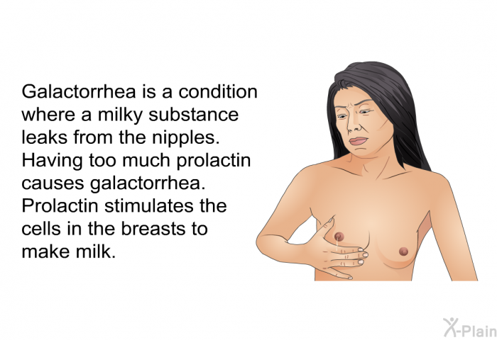 Galactorrhea is a condition where a milky substance leaks from the nipples. Having too much prolactin causes galactorrhea. Prolactin stimulates the cells in the breasts to make milk.
