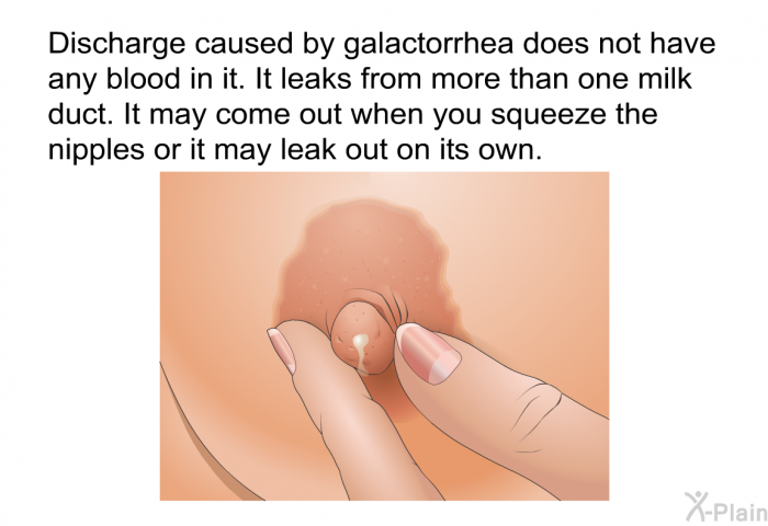 Discharge caused by galactorrhea does not have any blood in it. It leaks from more than one milk duct. It may come out when you squeeze the nipples or it may leak out on its own.