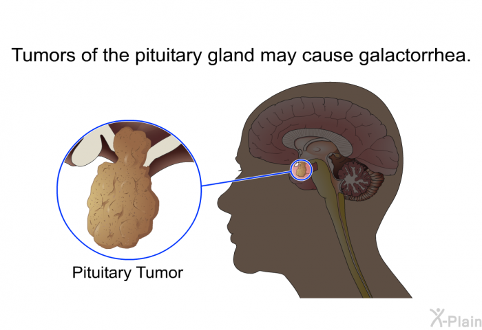 Tumors of the pituitary gland may cause galactorrhea.