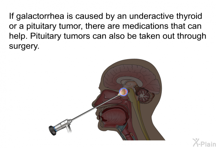 If galactorrhea is caused by an underactive thyroid or a pituitary tumor, there are medications that can help. Pituitary tumors can also be taken out through surgery.