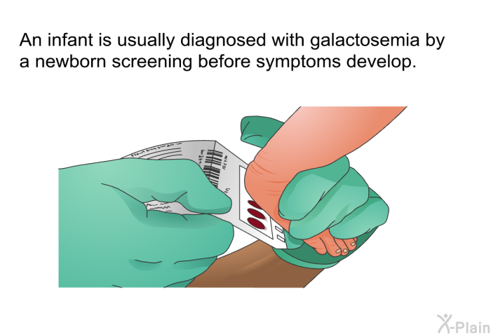An infant is usually diagnosed with galactosemia by a newborn screening before symptoms develop.