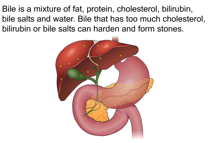 Bile is a mixture of fat, protein, cholesterol, bilirubin, bile salts and water. Bile that has too much cholesterol, bilirubin or bile salts can harden and form stones.