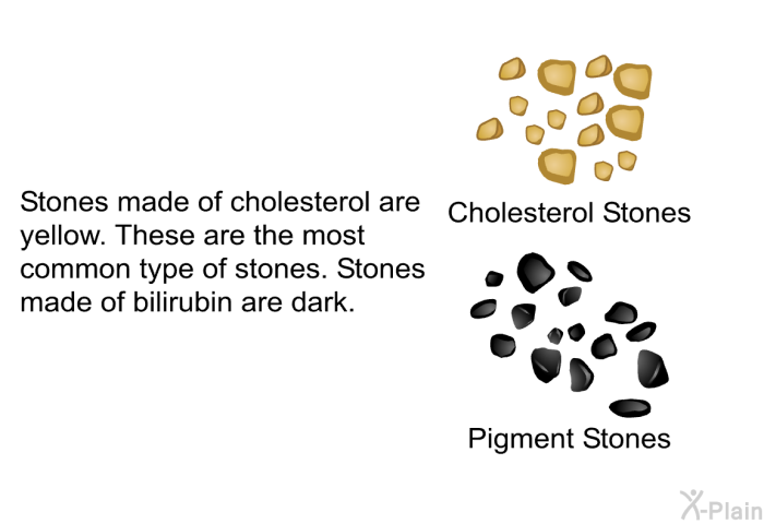 Stones made of cholesterol are yellow. These are the most common type of stones. Stones made of bilirubin are dark.