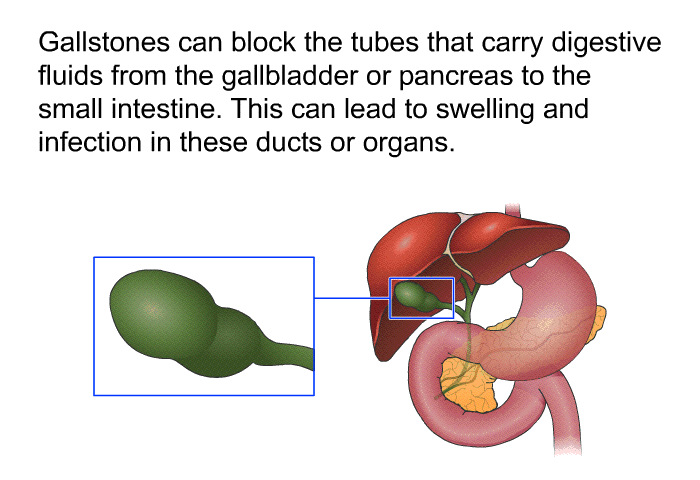 Gallstones can block the tubes that carry digestive fluids from the gallbladder or pancreas to the small intestine. This can lead to swelling and infection in these ducts or organs.