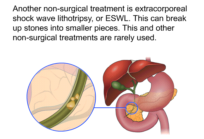 Another non-surgical treatment is extracorporeal shock wave lithotripsy, or ESWL. This can break up stones into smaller pieces. This and other non-surgical treatments are rarely used.