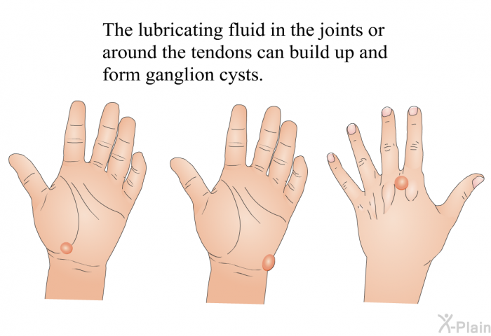 The lubricating fluid in the joints or around the tendons can build up and form ganglion cysts.