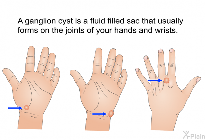 A ganglion cyst is a fluid filled sac that usually forms on the joints of your hands and wrists.