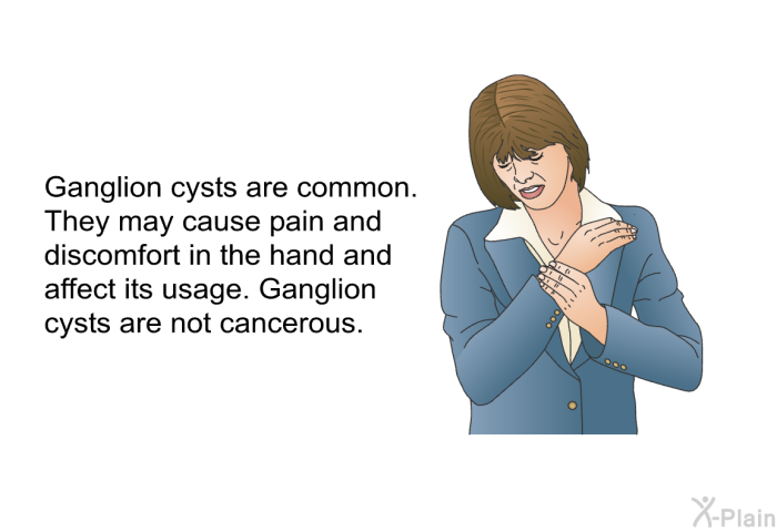 Ganglion cysts are common. They may cause pain and discomfort in the hand and affect its usage. Ganglion cysts are not cancerous.