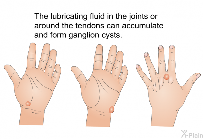 The lubricating fluid in the joints or around the tendons can accumulate and form ganglion cysts.