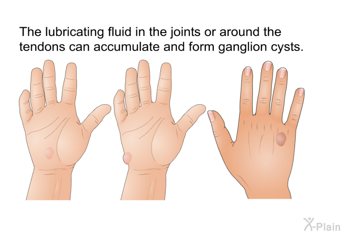 The lubricating fluid in the joints or around the tendons can accumulate and form ganglion cysts.