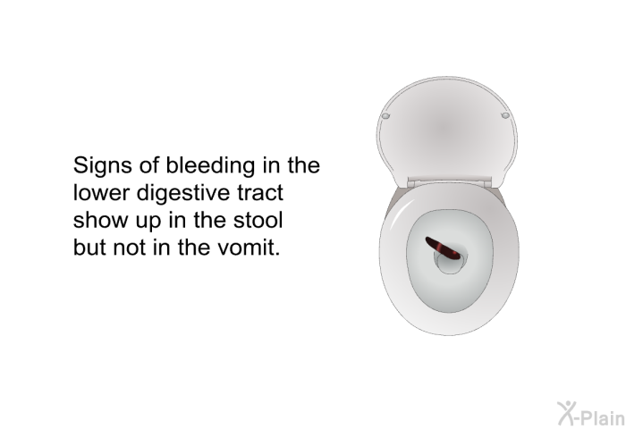 Signs of bleeding in the lower digestive tract show up in the stool but not in the vomit.