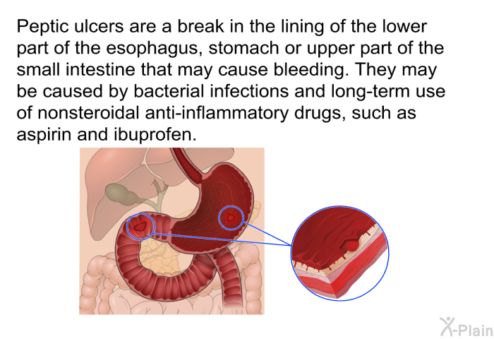 Peptic ulcers are a break in the lining of the lower part of the esophagus, stomach or upper part of the small intestine that may cause bleeding. They may be caused by bacterial infections and long-term use of nonsteroidal anti-inflammatory drugs, such as aspirin and ibuprofen.