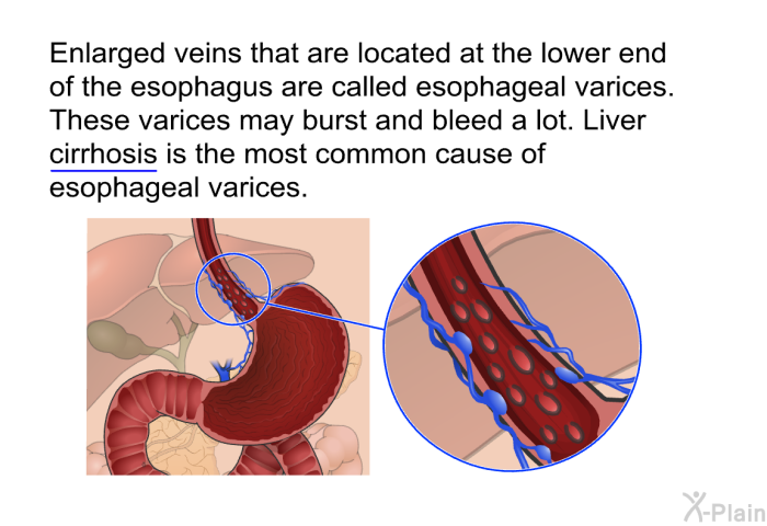 Enlarged veins that are located at the lower end of the esophagus are called esophageal varices. These varices may burst and bleed a lot. Liver cirrhosis is the most common cause of esophageal varices.