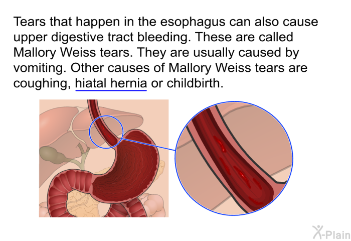 Tears that happen in the esophagus can also cause upper digestive tract bleeding. These are called Mallory Weiss tears. They are usually caused by vomiting. Other causes of Mallory Weiss tears are coughing, hiatal hernia or childbirth.