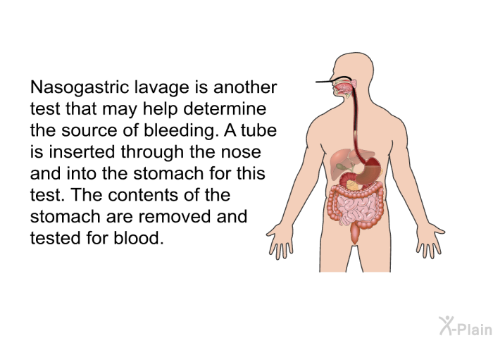 Nasogastric lavage is another test that may help determine the source of bleeding. A tube is inserted through the nose and into the stomach for this test. The contents of the stomach are removed and tested for blood.