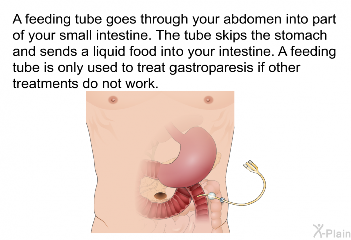 A feeding tube goes through your abdomen into part of your small intestine. The tube skips the stomach and sends a liquid food into your intestine. A feeding tube is only used to treat gastroparesis if other treatments do not work.
