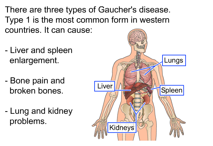 There are three types of Gaucher's disease. Type 1 is the most common form in western countries. It can cause:  Liver and spleen enlargement. Bone pain and broken bones. Lung and kidney problems.