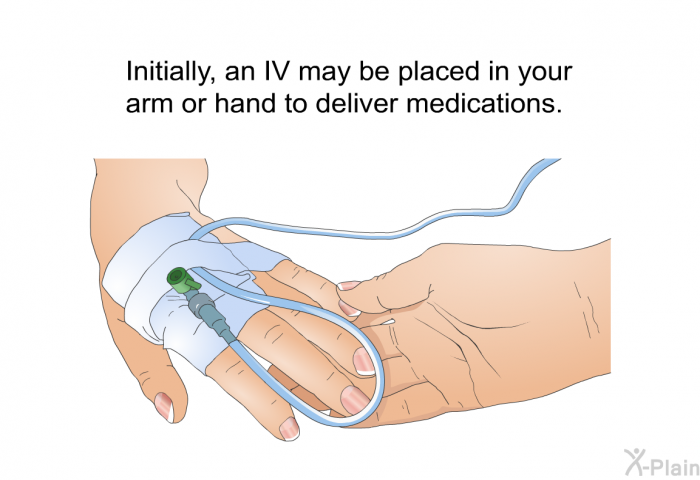 Initially, an IV may be placed in your arm or hand to deliver medications.