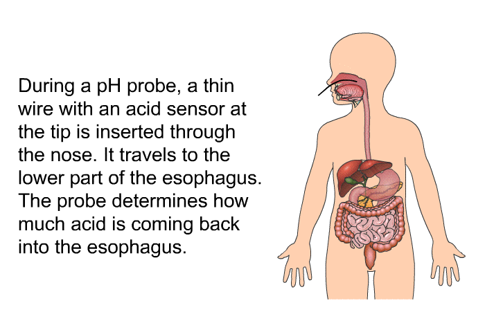 During a pH probe, a thin wire with an acid sensor at the tip is inserted through the nose. It travels to the lower part of the esophagus. The probe determines how much acid is coming back into the esophagus.