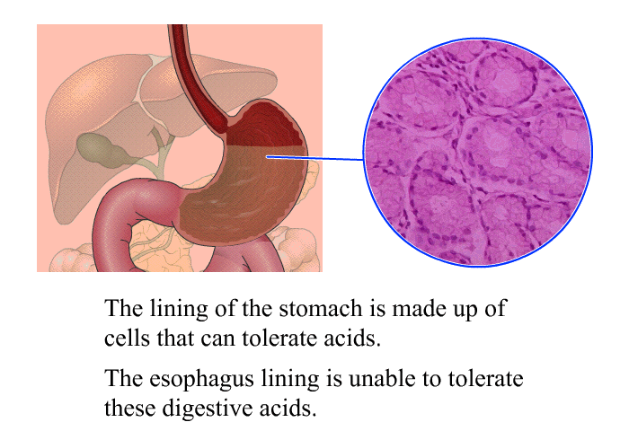 The lining of the stomach is made up of cells that can tolerate acids. The esophagus lining is unable to tolerate these digestive acids.