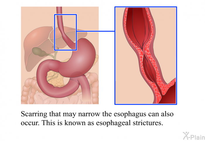Scarring that may narrow the esophagus can also occur. This is known as esophageal strictures.
