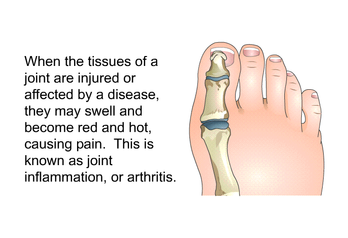 When the tissues of a joint are injured or affected by a disease, they may swell and become red and hot, causing pain. This is known as joint inflammation, or arthritis.