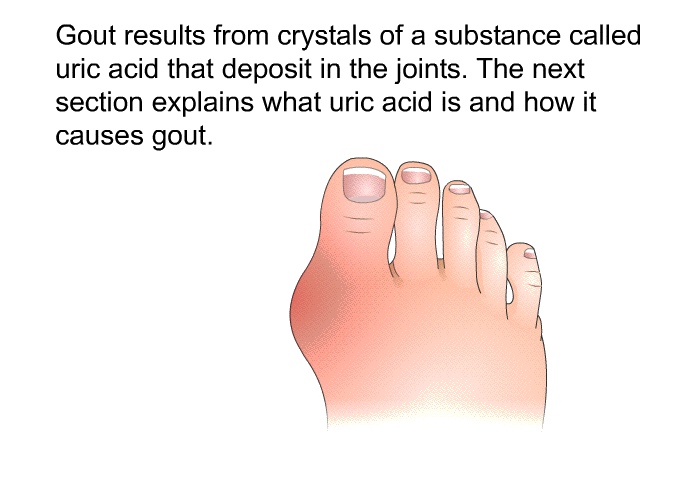 Gout results from crystals of a substance called uric acid that deposit in the joints. The next section explains what uric acid is and how it causes gout.