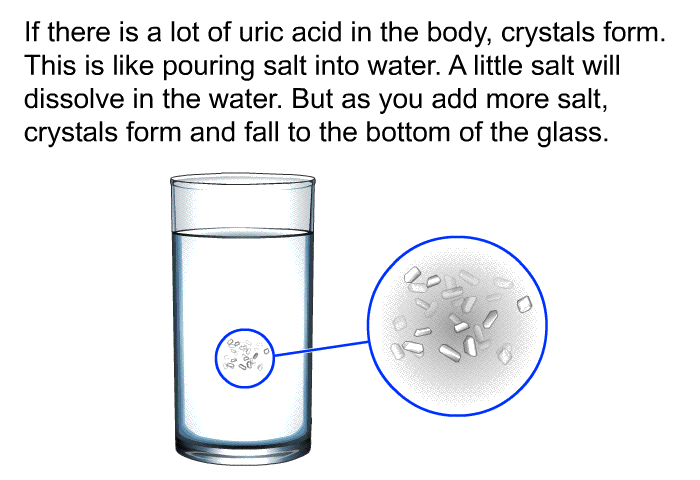 If there is a lot of uric acid in the body, crystals form. This is like pouring salt into water. A little salt will dissolve in the water. But as you add more salt, crystals form and fall to the bottom of the glass.