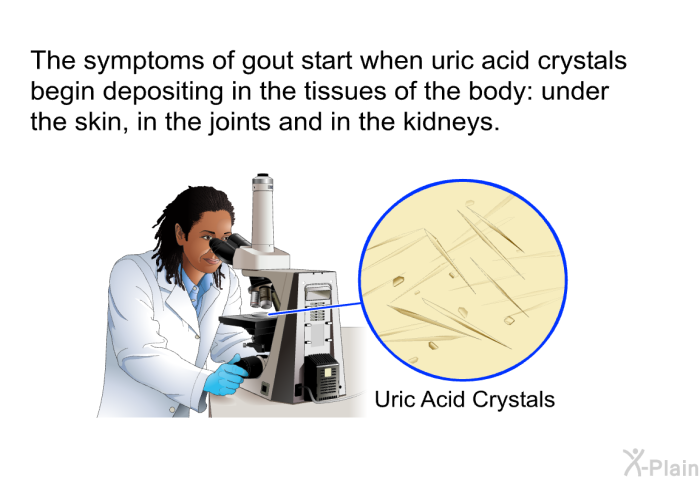 The symptoms of gout start when uric acid crystals begin depositing in the tissues of the body: under the skin, in the joints and in the kidneys.