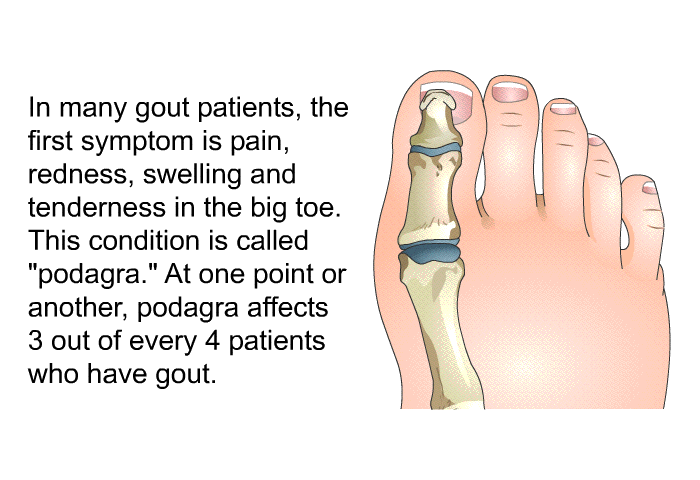 In many gout patients, the first symptom is pain, redness, swelling and tenderness in the big toe. This condition is called “podagra.” At one point or another, podagra affects 3 out of every 4 patients who have gout.