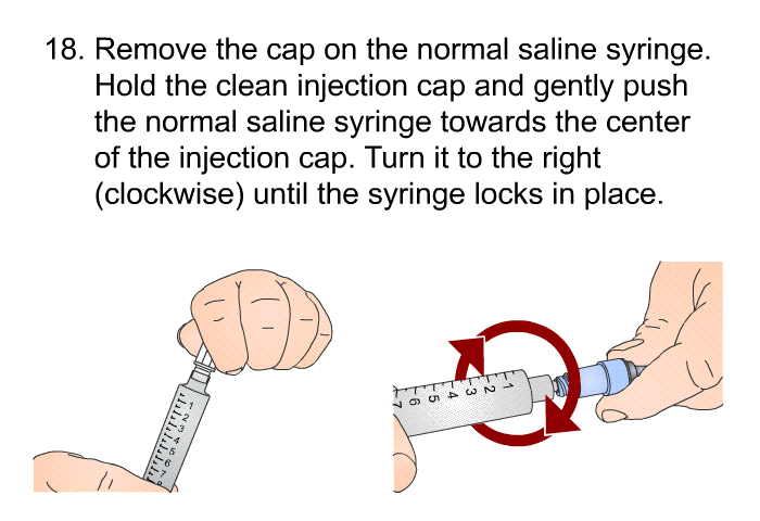 <OL START=18> Remove the cap on the normal saline syringe. Hold the clean injection cap and gently push the normal saline syringe towards the center of the injection cap. Turn it to the right (clockwise) until the syringe locks in place.