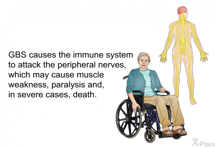 GBS causes the immune system to attack the peripheral nerves, which may cause muscle weakness, paralysis and, in severe cases, death.