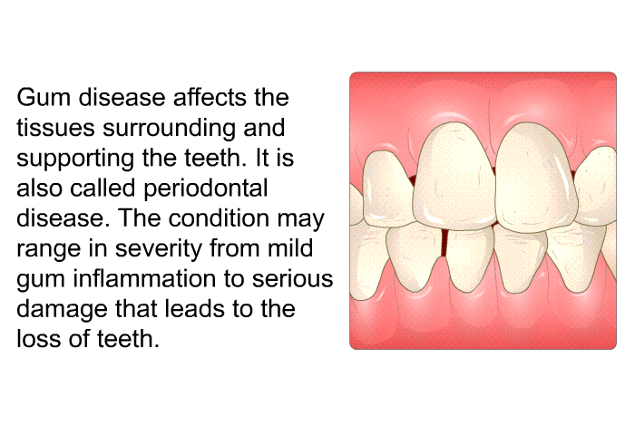 Gum disease affects the tissues surrounding and supporting the teeth. It is also called periodontal disease. The condition may range in severity from mild gum inflammation to serious damage that leads to the loss of teeth.