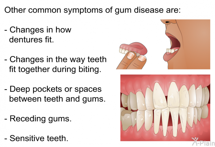 Other common symptoms of gum disease are:  Changes in how dentures fit. Changes in the way teeth fit together during biting. Deep pockets or spaces between teeth and gums. Receding gums. Sensitive teeth.