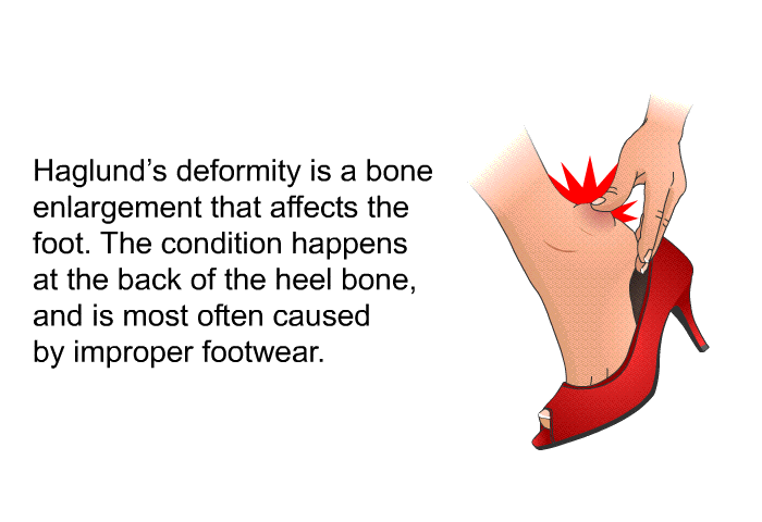 Haglund's deformity is a bone enlargement that affects the foot. The condition happens at the back of the heel bone, and is most often caused by improper footwear.