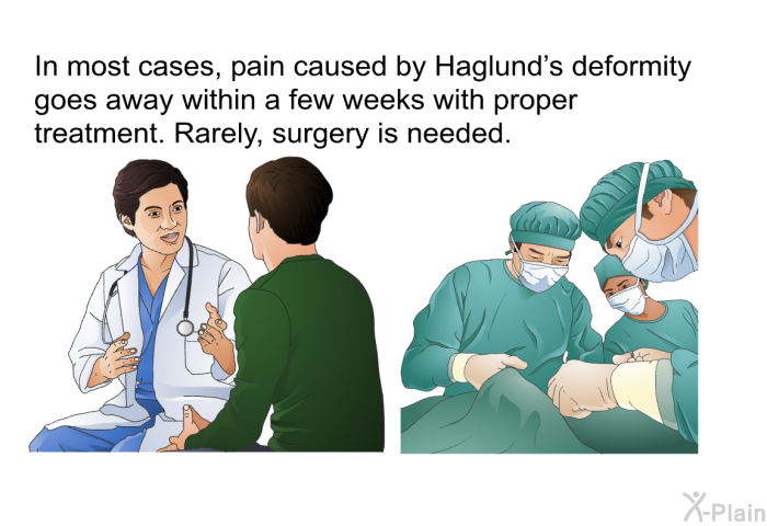 In most cases, pain caused by Haglund's deformity goes away within a few weeks with proper treatment. Rarely, surgery is needed.