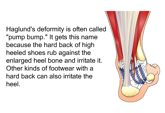 Haglund's deformity is often called “pump bump.” It gets this name because the hard back of high heeled shoes rub against the enlarged heel bone and irritate it. Other kinds of footwear with a hard back can also irritate the heel.