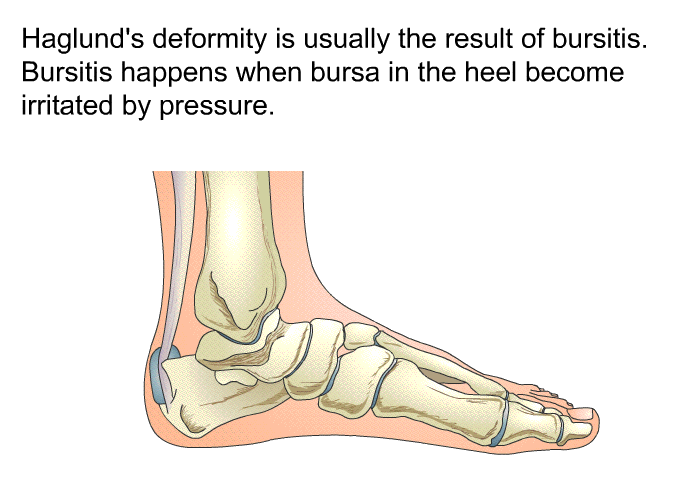 Haglund's deformity is usually the result of bursitis. Bursitis happens when bursa in the heel become irritated by pressure.