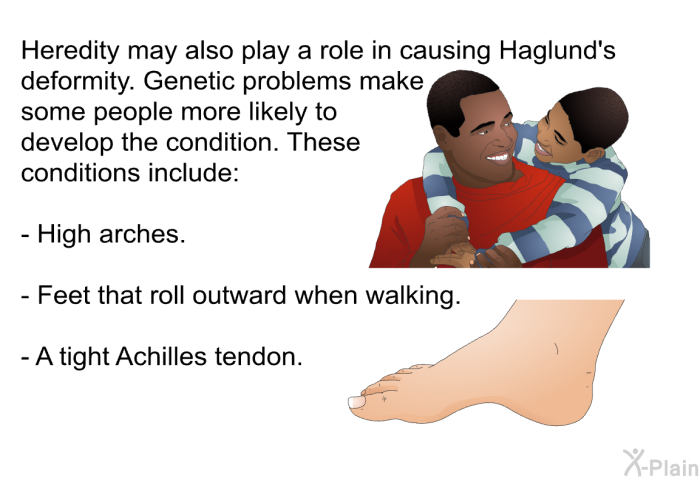 Heredity may also play a role in causing Haglund's deformity. Genetic problems make some people more likely to develop the condition. These conditions include:  High arches. Feet that roll outward when walking. A tight Achilles tendon.