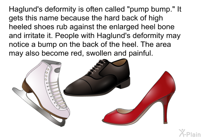Haglund's deformity is often called “pump bump.” It gets this name because the hard back of high heeled shoes rub against the enlarged heel bone and irritate it. People with Haglund's deformity may notice a bump on the back of the heel. The area may also become red, swollen and painful.
