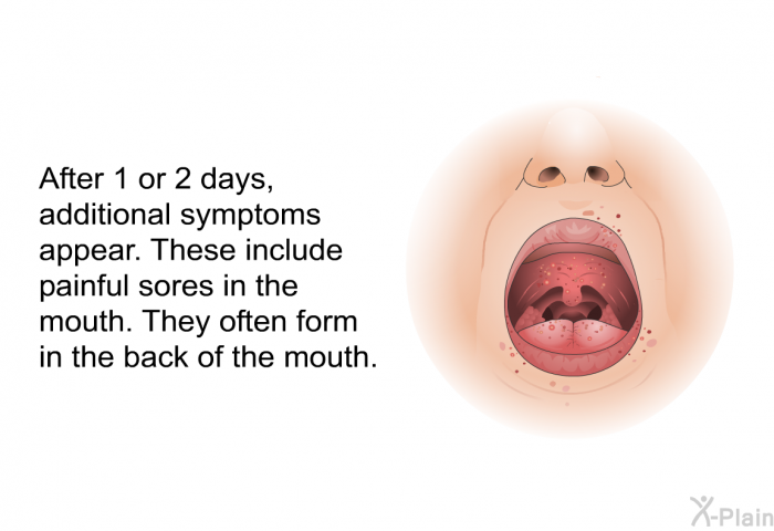 After 1 or 2 days, additional symptoms appear. These include painful sores in the mouth. They often form in the back of the mouth.