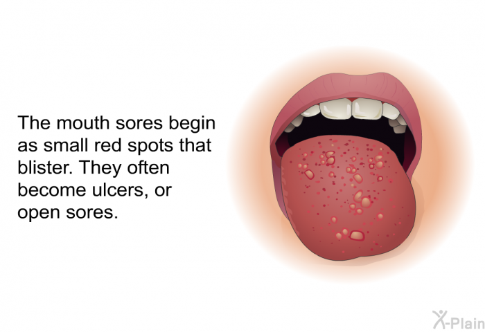The mouth sores begin as small red spots that blister. They often become ulcers, or open sores.